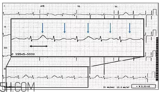 心電圖怎么看？6種常見心電圖異常情況