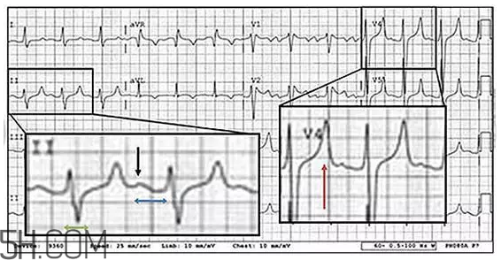 心電圖怎么看？6種常見心電圖異常情況
