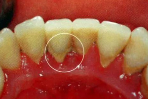 牙結(jié)石能自動(dòng)脫落嗎？除了洗牙別無(wú)他法