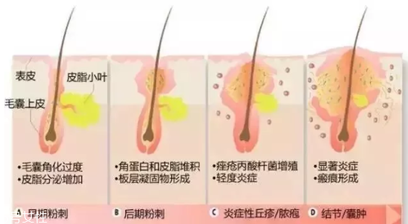 封閉性粉刺的發(fā)病機(jī)制是什么？角質(zhì)層太厚