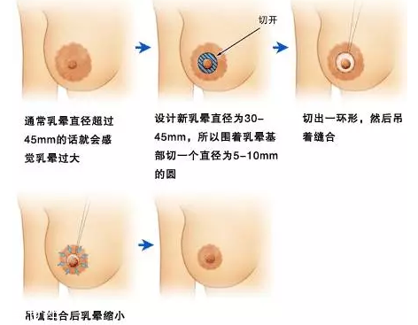 乳暈縮小術(shù)怎么做？乳暈縮小術(shù)知識全解