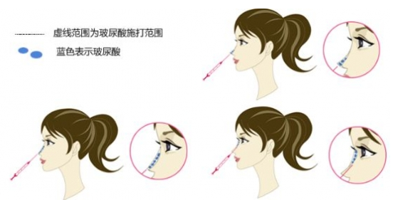 鼻子整形有幾種方法 鼻子整形哪種方法最好