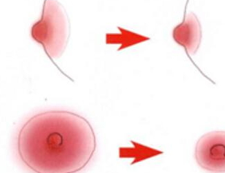 乳暈縮小術(shù)全千萬別做 乳暈縮小術(shù)不宜人群