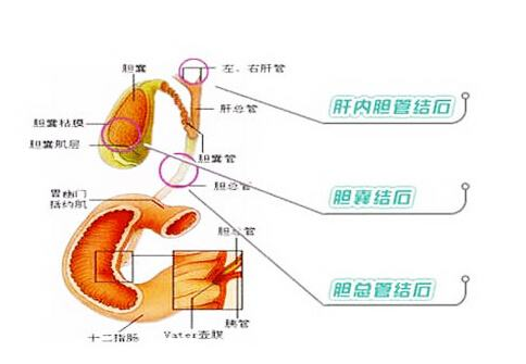 膽結(jié)石的食療方法 如何預(yù)防膽結(jié)石