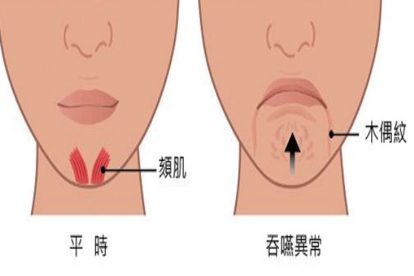 木偶紋怎么消除 讓你笑起來(lái)更自信