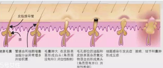 臉上閉口太多怎么辦 臉上長(zhǎng)閉口怎么調(diào)理