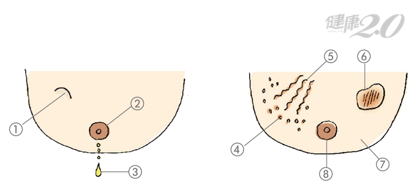 怎樣判斷乳房健康 每月3步驟自我檢查