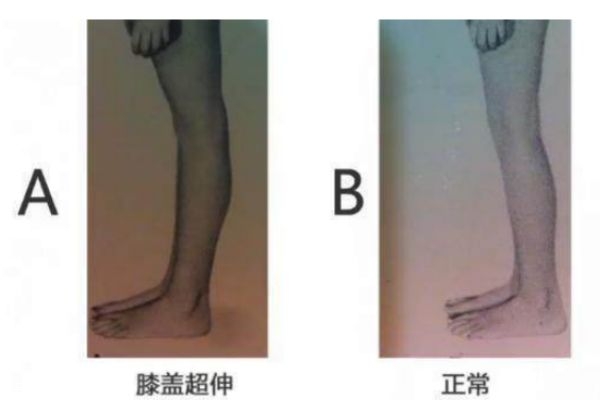 膝關(guān)節(jié)超伸的表現(xiàn) 快來自測一下把