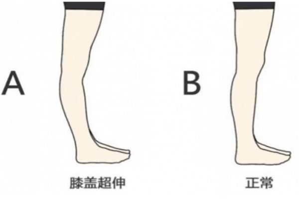 膝關節(jié)超伸的表現(xiàn) 快來自測一下把