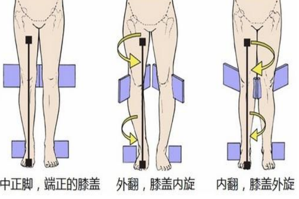 膝蓋超伸可以恢復(fù)嗎 可以通過鍛煉改善