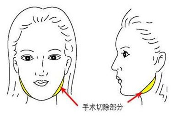 什么人適合下頜角整形手術(shù) 下頜角整形手術(shù)多久能消腫