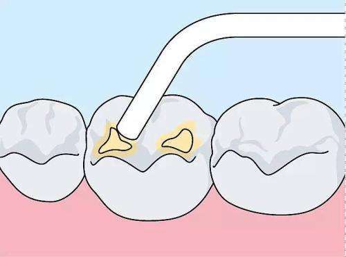 補(bǔ)牙后可以吃什么 牙齒有洞不補(bǔ)會怎樣