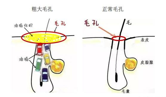 臉上毛孔粗大像雞皮一樣怎么辦