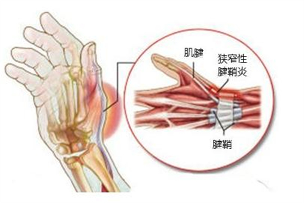 腱鞘炎是怎么形成的 腱鞘炎有什么癥狀