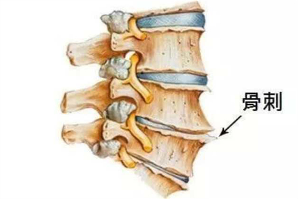 骨質(zhì)增生是怎么引起的 骨質(zhì)增生有哪些癥狀表現(xiàn)