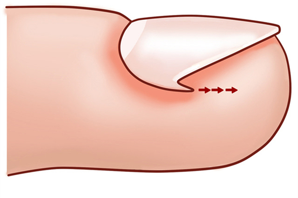甲溝炎指甲長(zhǎng)出來(lái)就好了嗎 甲溝炎指甲長(zhǎng)肉里好深怎么辦