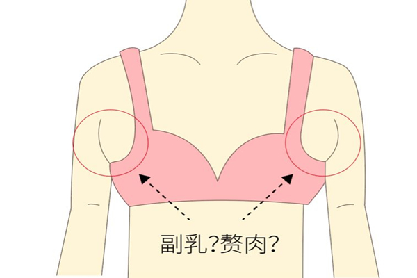 副乳切除好還是不切 副乳切除會(huì)留疤嗎