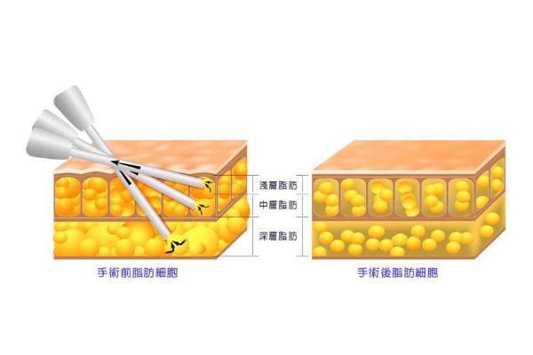 抽脂肪對(duì)身體有什么副作用 抽脂手術(shù)大概花多少錢(qián)