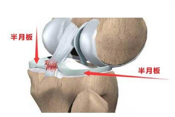 徐夢桃摘金背后:半月板切除70% 半月板損傷怎么造成的