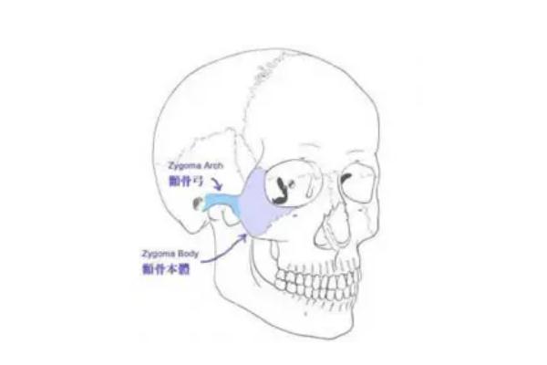 顴骨內(nèi)推手術(shù)多少錢(qián)啊 顴骨內(nèi)推后遺癥